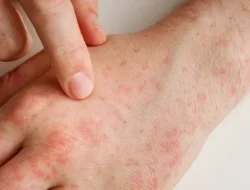 Bukan Cuma Gatal! Ini 7 Alasan Bercak Merah Muncul di Kulit Tanpa Rasa Gatal yang Wajib Kamu Tahu