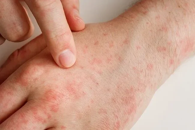 bukan cuma gatal ini 7 alasan bercak merah muncul di kulit tanpa rasa gatal yang wajib kamu tahu portal berita terbaru