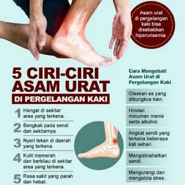 Ilustrasi 5 ciri-ciri asam urat di pergelangan kaki dan cara mengobatinya.