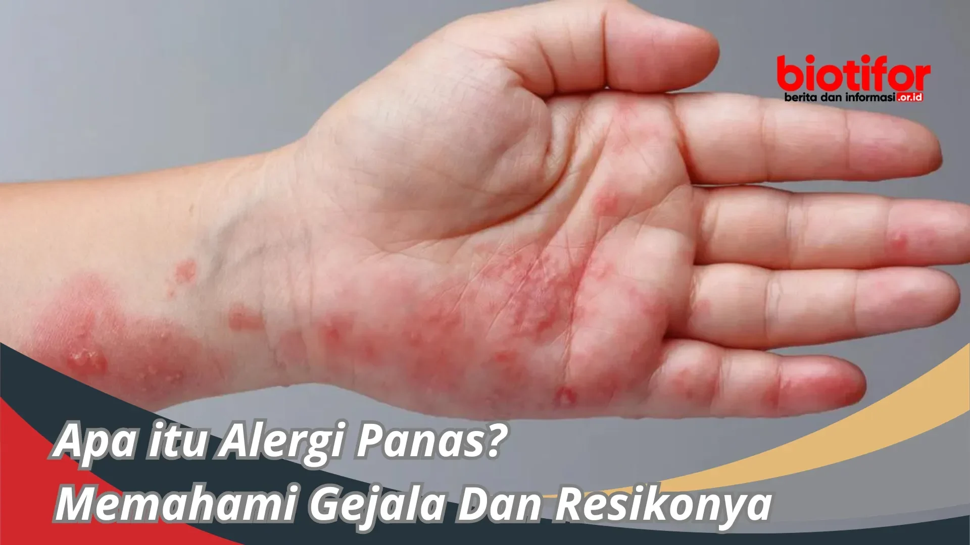 Ruam merah dan iritasi pada telapak tangan, gejala alergi atau keracunan makanan.