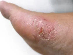 Waspada! 10 Perubahan Kulit Ini Ternyata Alarm Diabetes yang Sering Kamu Abaikan