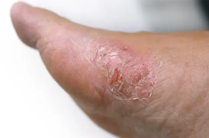 Luka pada kulit kaki yang kering dan mengelupas, diduga terkait diabetes.