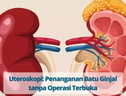 Batu Ginjal Bisa Keluar Sendiri? Ini Rahasia dan Tanda-tandanya yang Wajib Kamu Tahu!