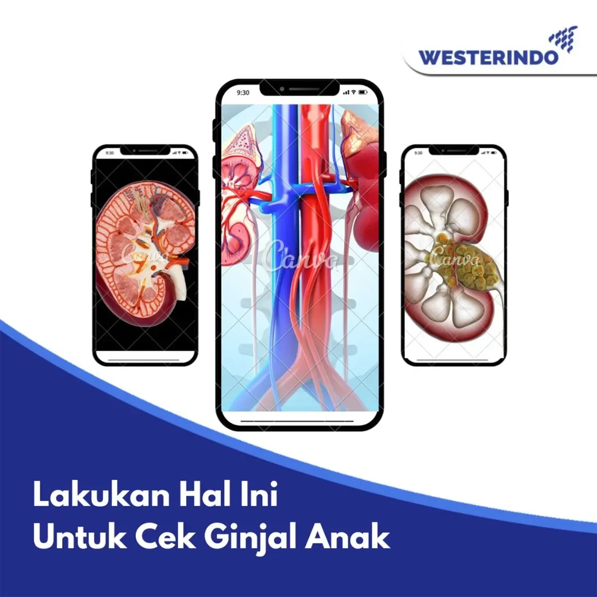 Jangan Anggap Remeh! Ini Tanda Ginjal Bocor yang Sering Diabaikan, Cek Sekarang! 1 jangan anggap remeh ini tanda ginjal bocor yang sering diabaikan cek sekarang portal berita terbaru