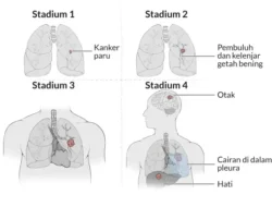 Jangan Anggap Remeh! Perubahan Kuku Ini Bisa Jadi Tanda Awal Kanker Paru yang Sering Terlewat