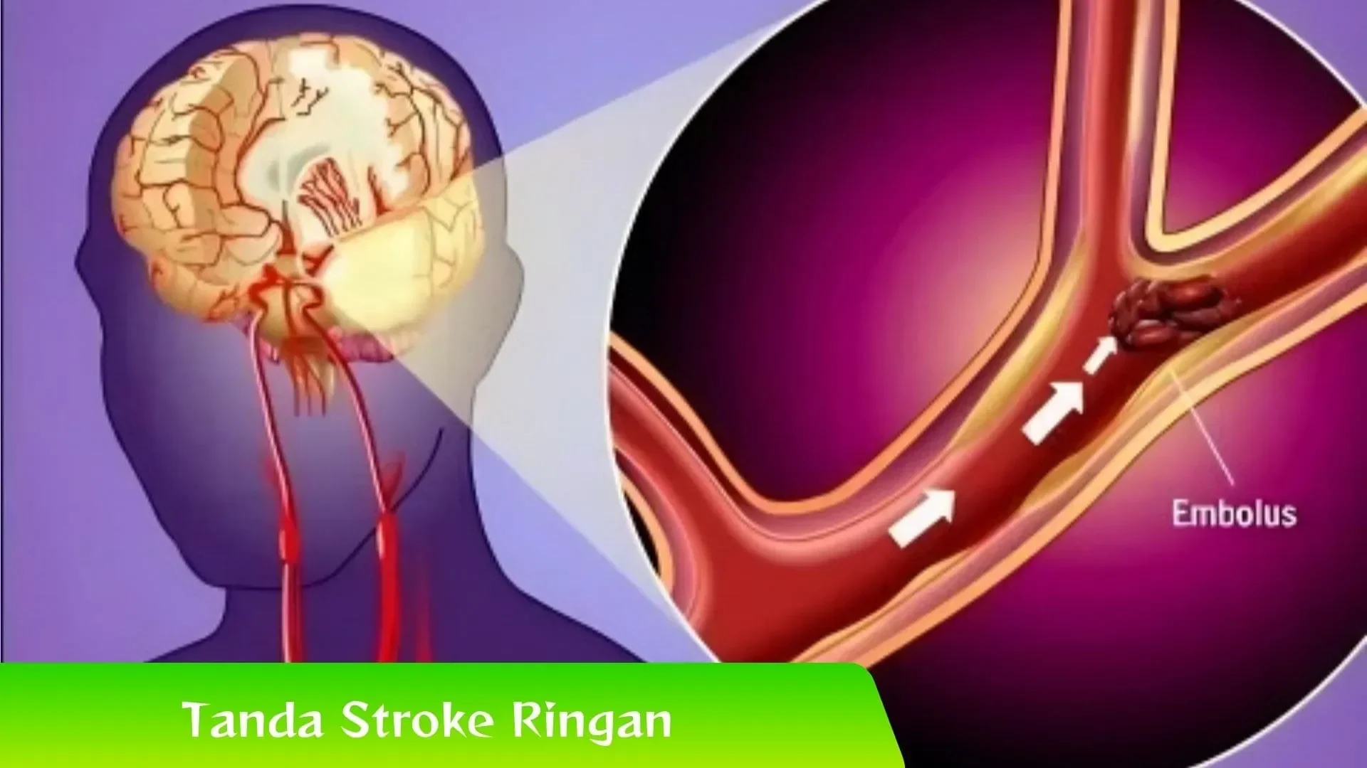 kabar mengejutkan kak seto dilarikan ke rs akibat stroke ringan dan aritmia begini gejala awal yang wajib diwaspadai portal berita terbaru