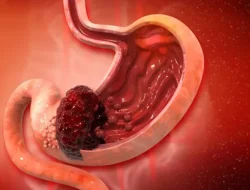 Sering Begah Setelah Ngemil? Waspada, Ini 5 Tanda Awal Kanker Lambung yang Sering Diabaikan!