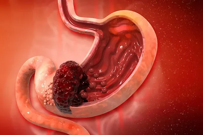 sering begah setelah ngemil waspada ini 5 tanda awal kanker lambung yang sering diabaikan portal berita terbaru