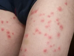 Waspada! Penumpang Scoot Alami Gatal-Gatal Parah, Curiga Kutu Busuk di Kabin Pesawat!