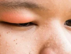 Awas! Mata Kering dan Bengkak Bisa Jadi Sinyal Ginjalmu Bermasalah, Kenali 4 Tanda Ini Sekarang!