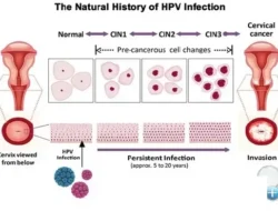 Jangan Anggap Sepele! 7 Gejala Kanker Kolon Onset Dini yang Kini Intai Anak Muda