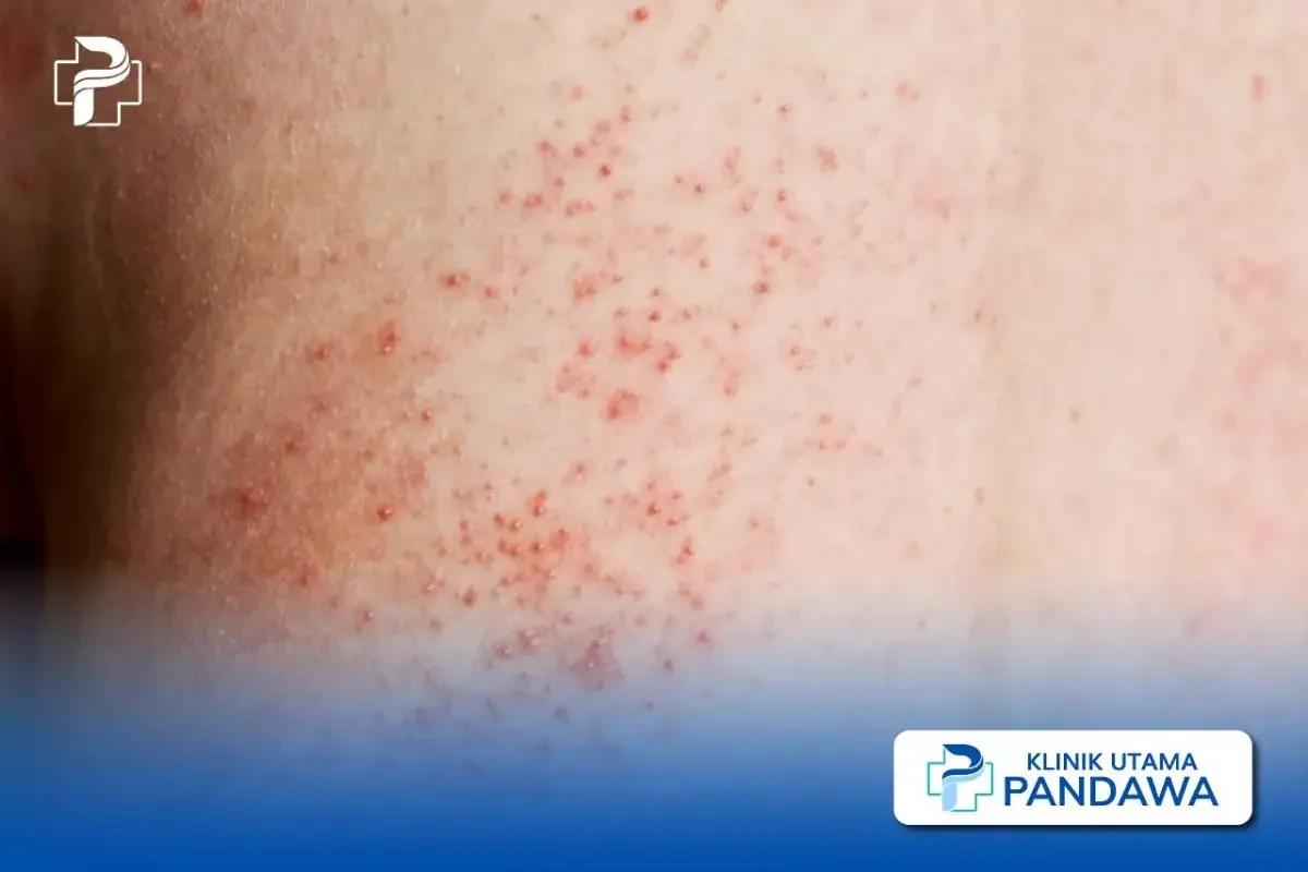 jangan panik bintik merah di penis ini 10 penyebabnya dari ringan sampai serius yang wajib kamu tahu portal berita terbaru