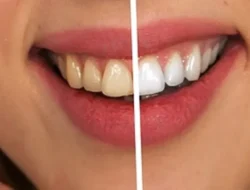 Rajin Sikat Gigi Tapi Kok Tetap Kuning? Ini 7 Biang Kerok Tak Terduga!